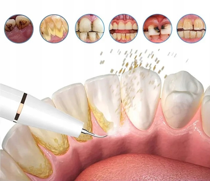 Skaler Ultradźwiękowy Do Zębów 3 Tryby Do Usuwania Kamienia Nazębnego Mocny