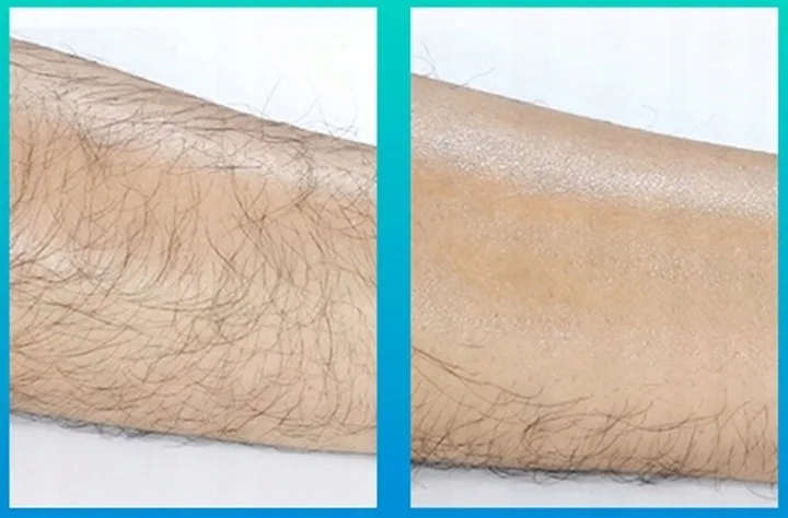 Depilator Bezbolesny Kryształowy Epilator Do Usuwania Włosów Depilacji